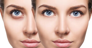 Dark Circles