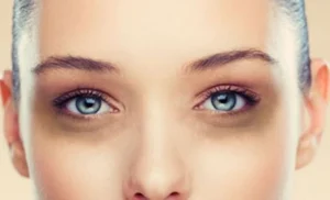 Dark Circles