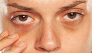 Puffiness