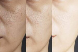 Large Pores